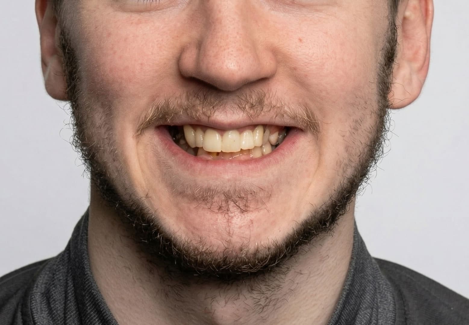 Patient smile before