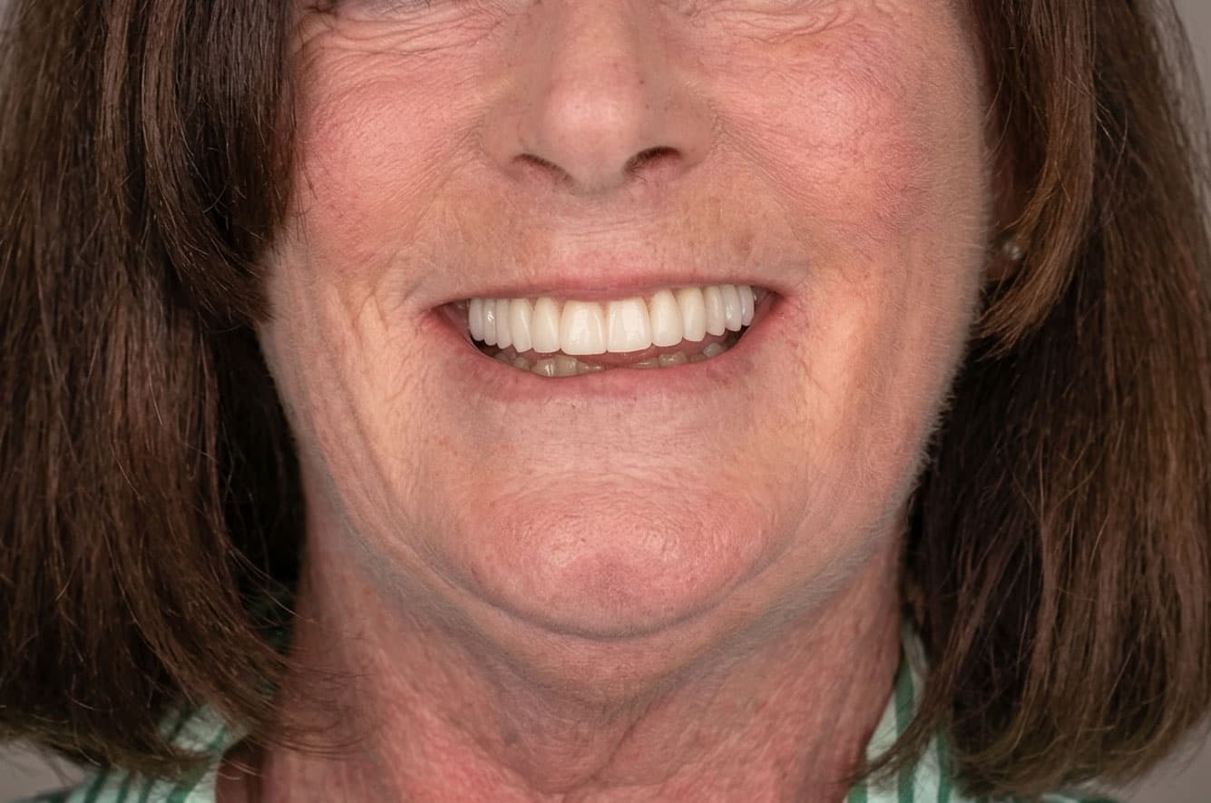 Patient smile after