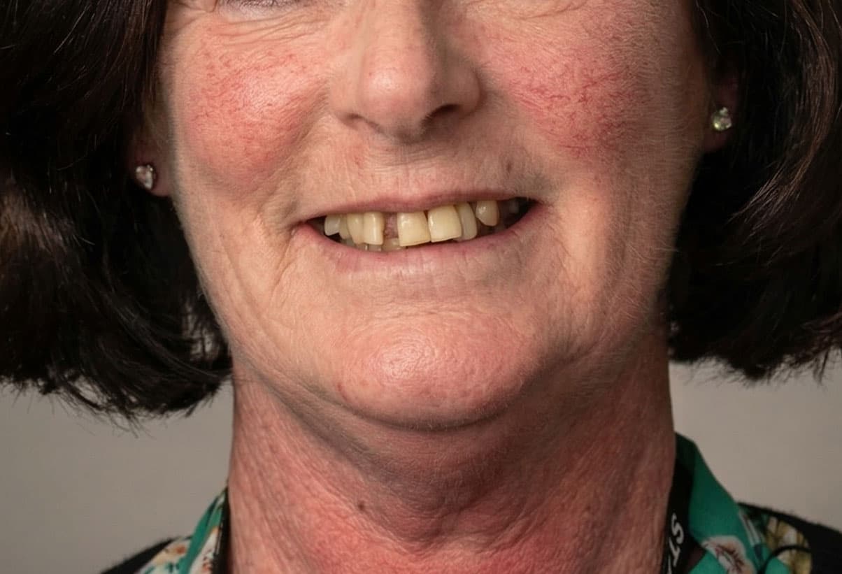 Patient smile before