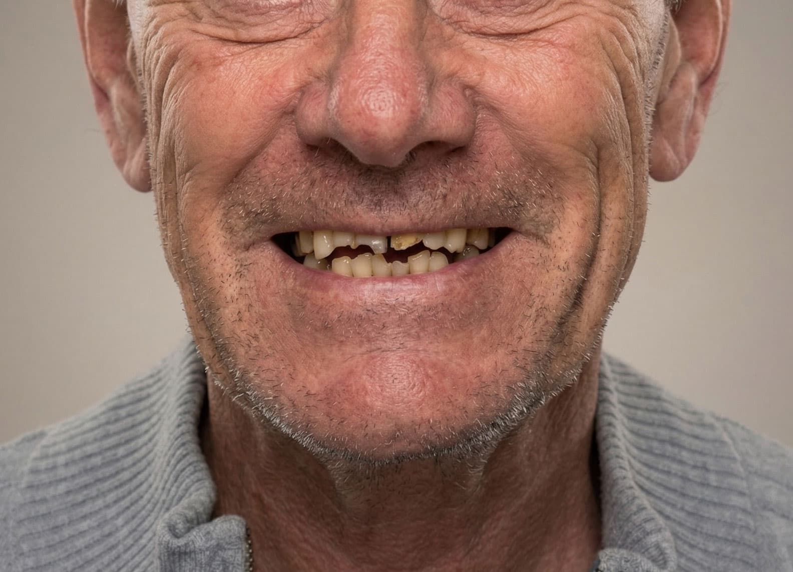 Patient smile before