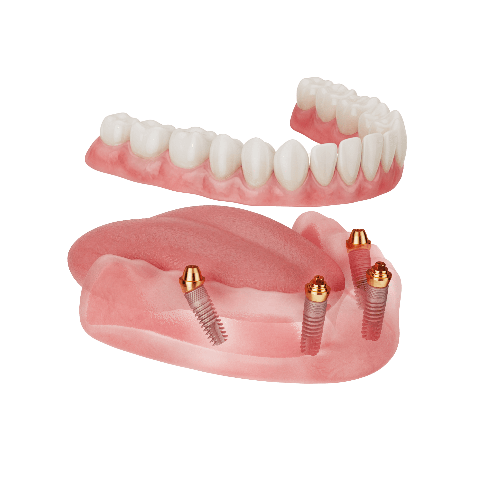 Single Arch illustration