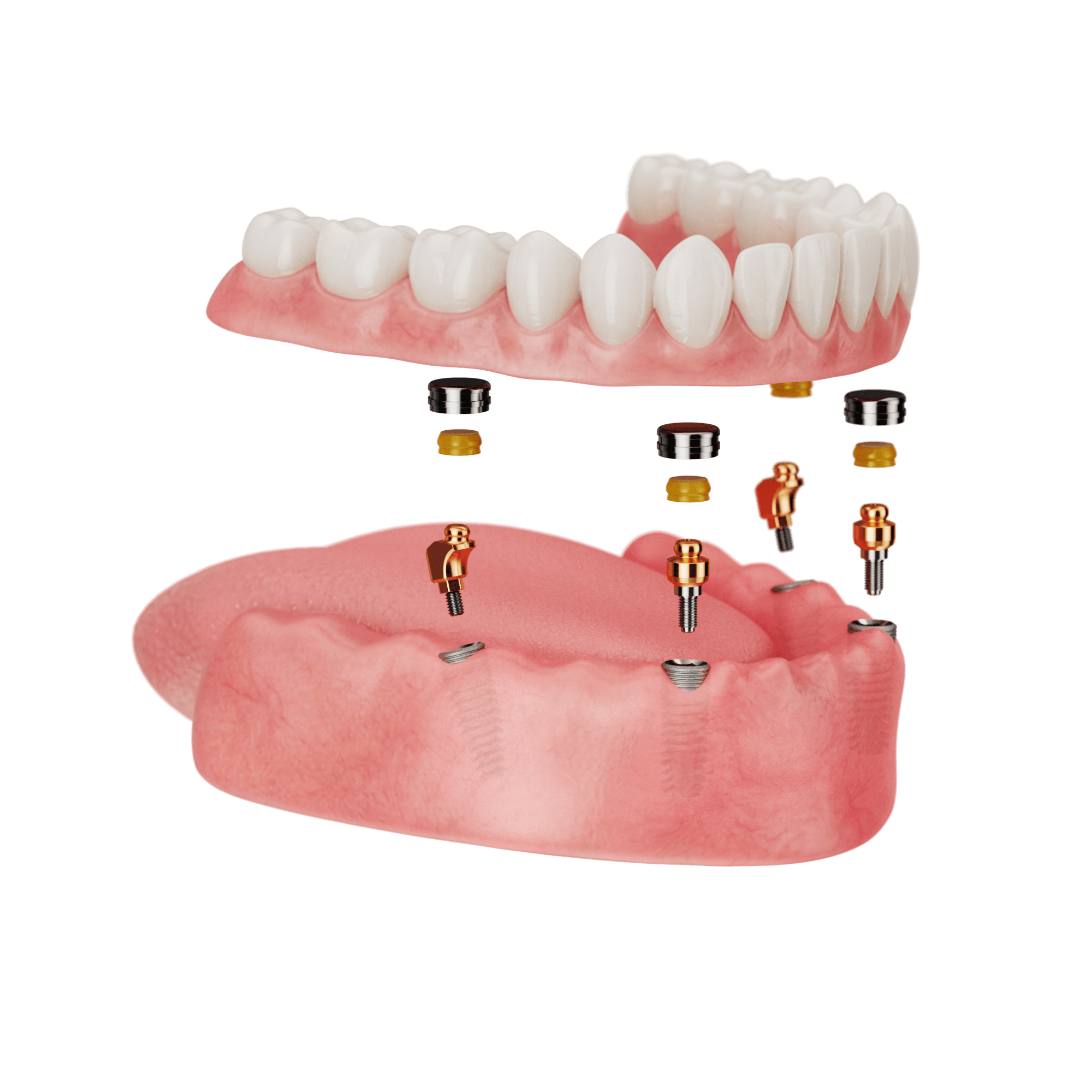 Overdentures